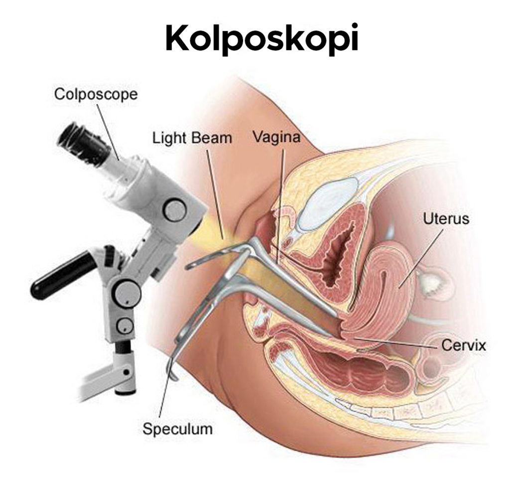 Kolposkopi